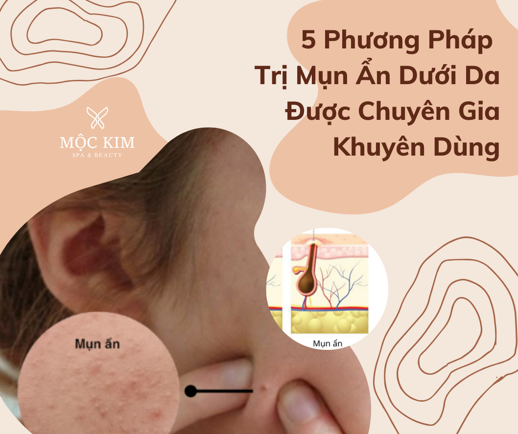5 Phương Pháp Trị Mụn Ẩn Dưới Da Được Chuyên Gia Khuyên Dùng 14 dai dien 45 - 5 Phương Pháp Trị Mụn Ẩn Dưới Da Được Chuyên Gia Khuyên Dùng