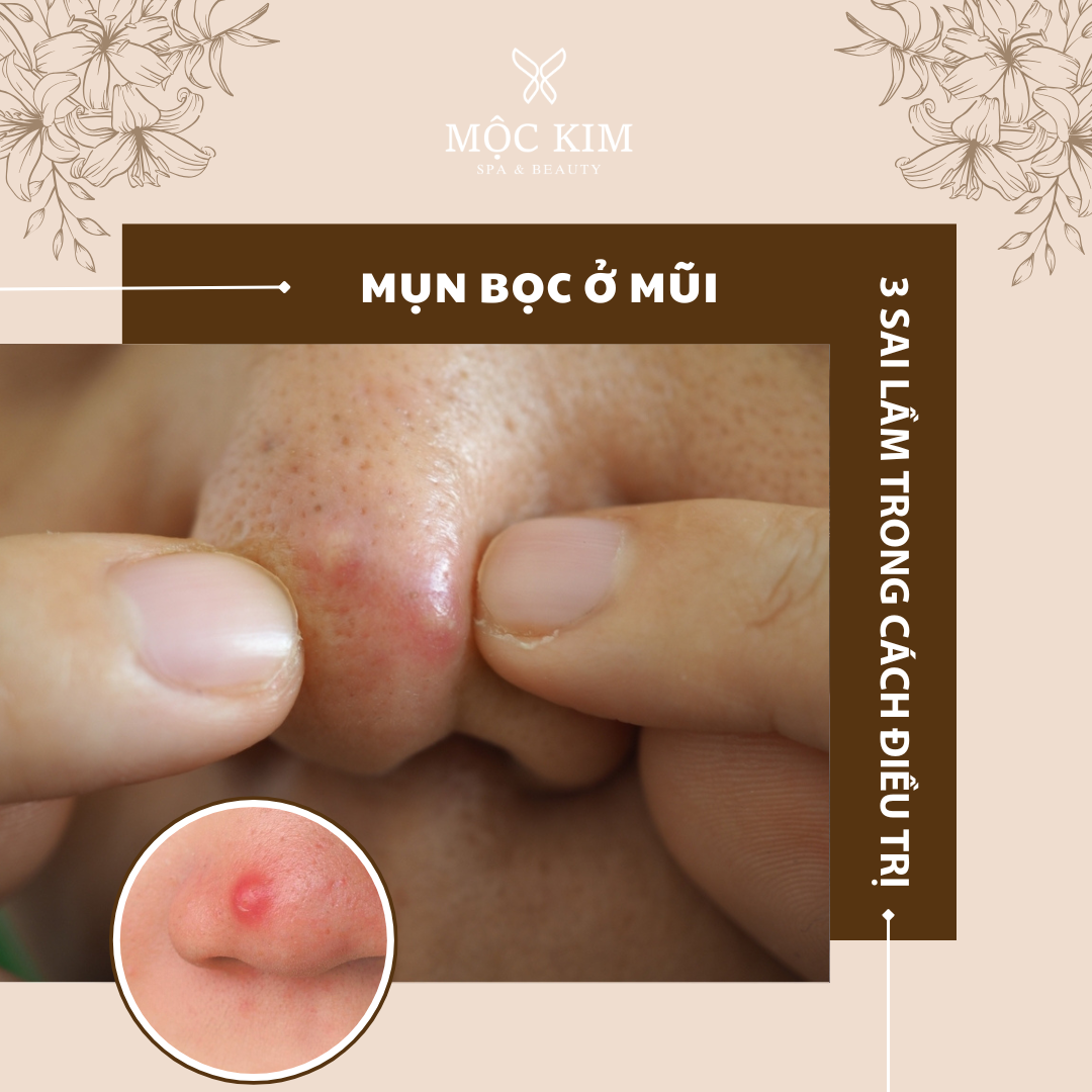 dai dien 6 - 3 Sai Lầm Trong Cách Điều Trị Mụn Bọc Ở Mũi Khiến Mụn Ngày Càng Nặng