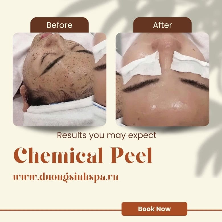 Peel Da Quận 1 TP.HCM – Liệu Trình Peel Sáng Da & Tái Tạo Collagen Tại Mộc Kim Spa 5 Peel da hồ chí minh kết quả